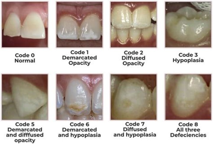 Can enamel hypoplasia be reversed