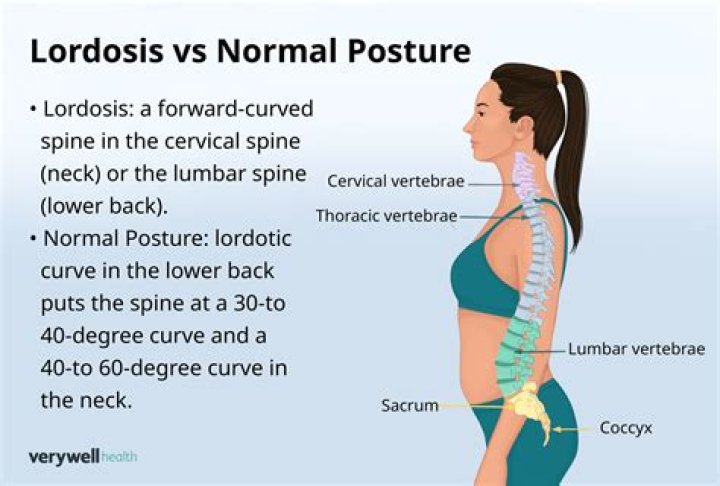 What degree of lordosis is normal