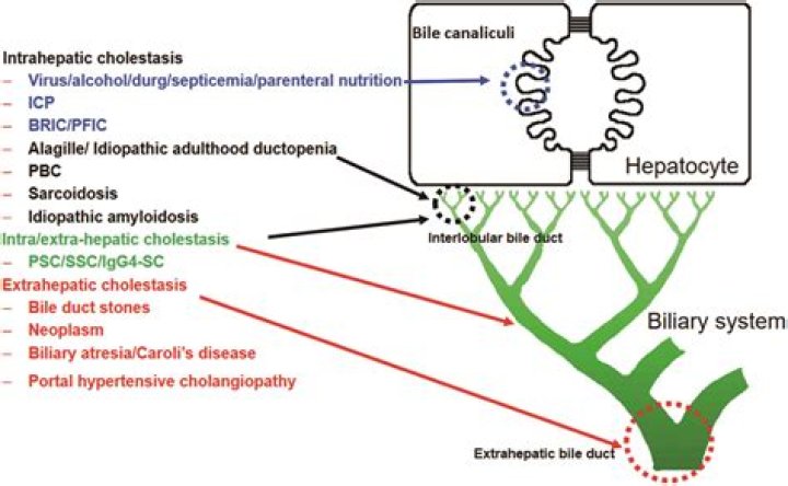 What is cholestatic liver disease