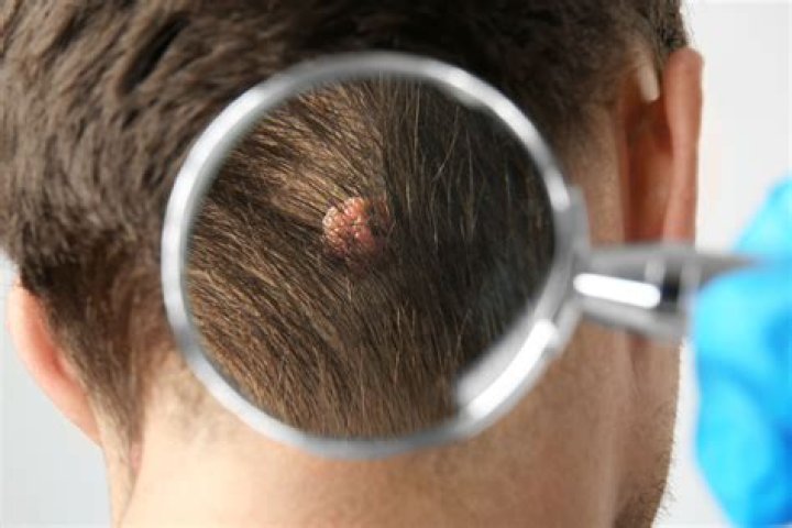 Will hair grow on cancerous moles
